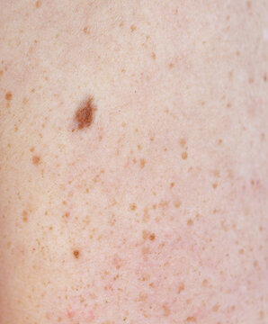 Close-up of skin with a single dark brown spot
