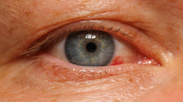 Close-up of human eye with visible redness and slight swelling