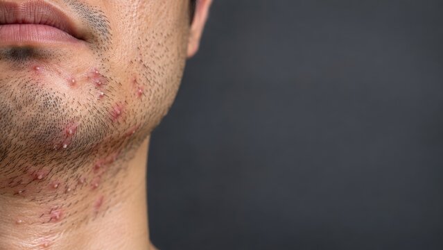 Close-Up of Male Chin and Neck with Folliculitis and Stubble