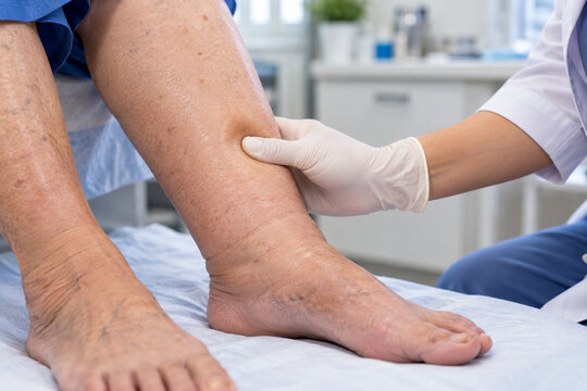 Pitting Edema Examination of Swollen Lower Leg in Older Patient
