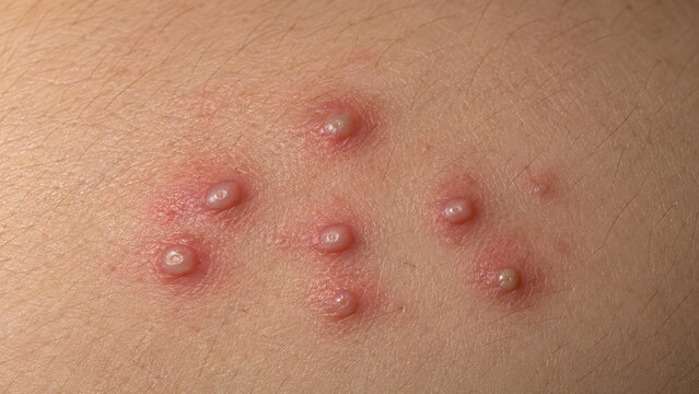 Mpox Skin Lesions on Human Skin, Characteristic Rash Medical Photography