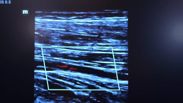 Medical ultrasound shows blood flow in vessels. Bright red and blue colors indicate direction. Screen displays real-time Doppler imaging. Image focuses on vascular structure