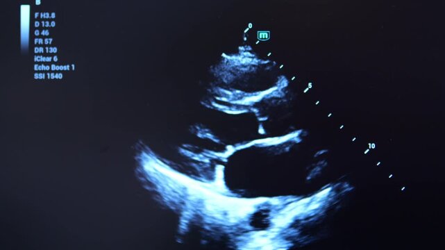 Ultrasound scan shows human heart chambers moving rhythmically. Bright blue imaging highlights muscle walls and fluid-filled spaces. Screen displays technical settings like gain and frame rate