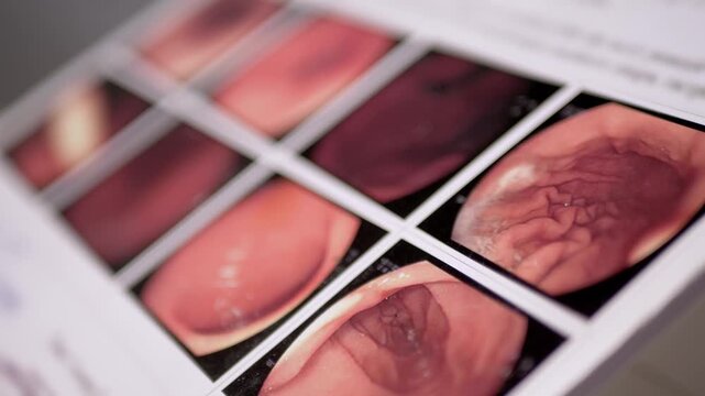 Endoscopy medical report shows detailed gastrointestinal scans in macro view. Angled perspective emphasizes shallow depth of field across printed endoscopic diagnostics.