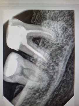 Dental X-ray displaying tooth structure and root canal treatment  