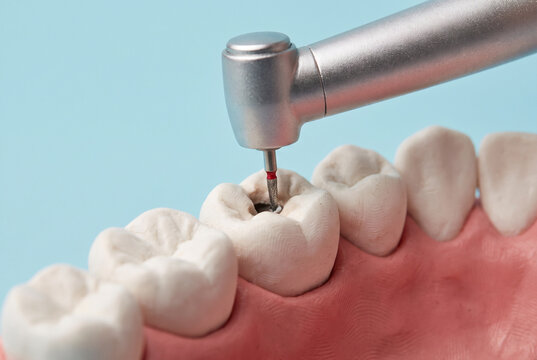 Close-up 3D dental treatment illustration showing cavity preparation with professional dental drill