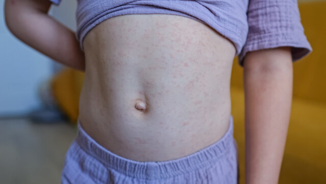 Young Child Stands Indoors Revealing Stomach Covered With Red Rash, Displaying Visible Allergic Reaction Or Viral Illness On Bare Skin While Wearing Soft Purple Textured Pajamas At Home.