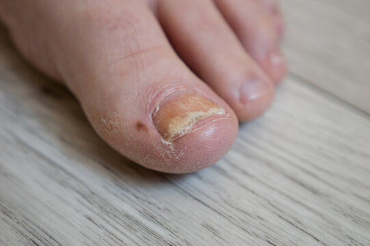 Macro View Presents Human Toe Showing Severe Nail Fungus Infection Beside Dry Peeling Skin. Unhealthy Yellowish Toenail Demonstrates Clear Need For Medical Dermatology Foot Care Therapy.