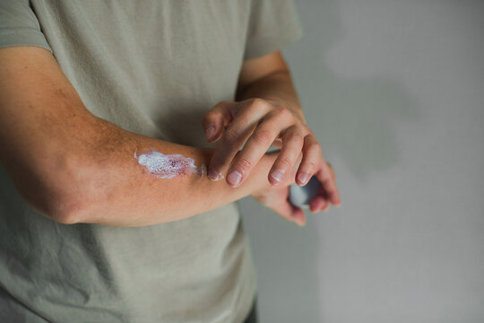 Person applying topical cream to an irritated forearm rash