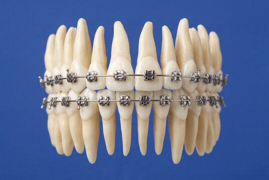 Orthodontic dental model with metal braces and visible tooth roots on blue background