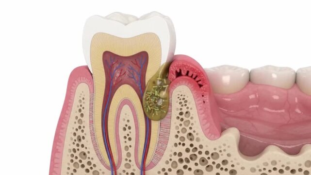 Dental infection affecting tooth root with visible bacteria causing gum inflammation and bone damage detailed medical illustration showing tooth anatomy cross section pulp root gum tissue decay
