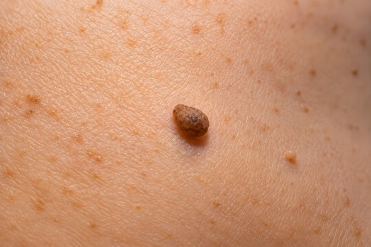 Macro view of a single mole on human skin epidermis with mark
