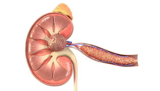 Renal Cell Carcinoma Extending into the Renal Vein 2