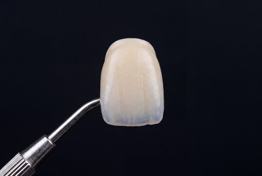 Dental veneer held by dental explorer on black background, close-up of ceramic front tooth restoration