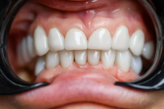 Macro of a healthy white smile with closed bite in a black lip retractor, upper and lower teeth with pink gums, dental whitening result, healthy teeth care, grainy film texture, high quality photo