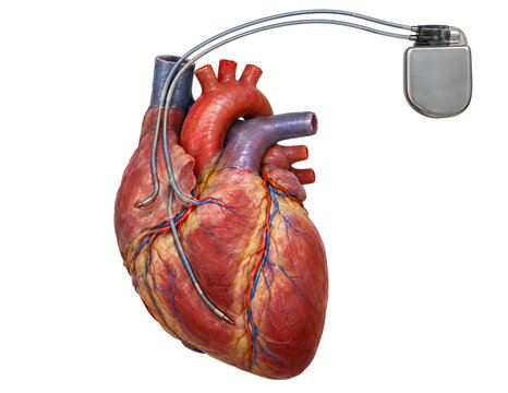 Human heart with pacemaker