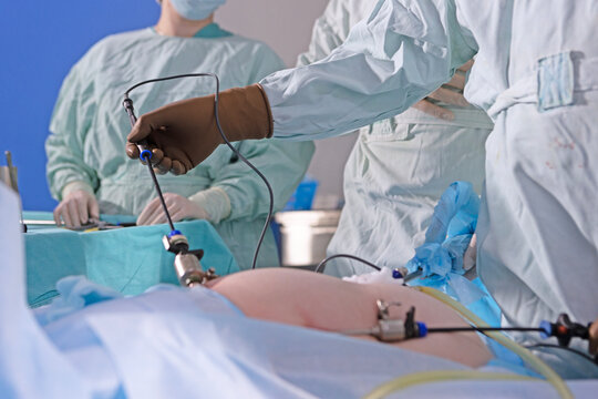 Surgeon in brown gloves holds laparoscope during laparoscopic surgery. Operating room. Trocars inserted in patient abdomen