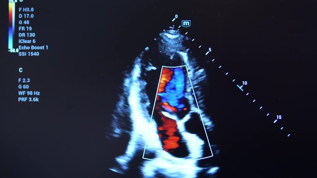 Echocardiogram showing heart structure and blood flow. Medical imaging captures cardiac chambers and valves in motion. Color Doppler highlights blood movement within the heart