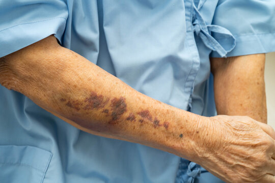 Ecchymosis, elderly bleeding on her arm after taking aspirin.